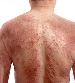 What Should I Do About Rashes and Hives?